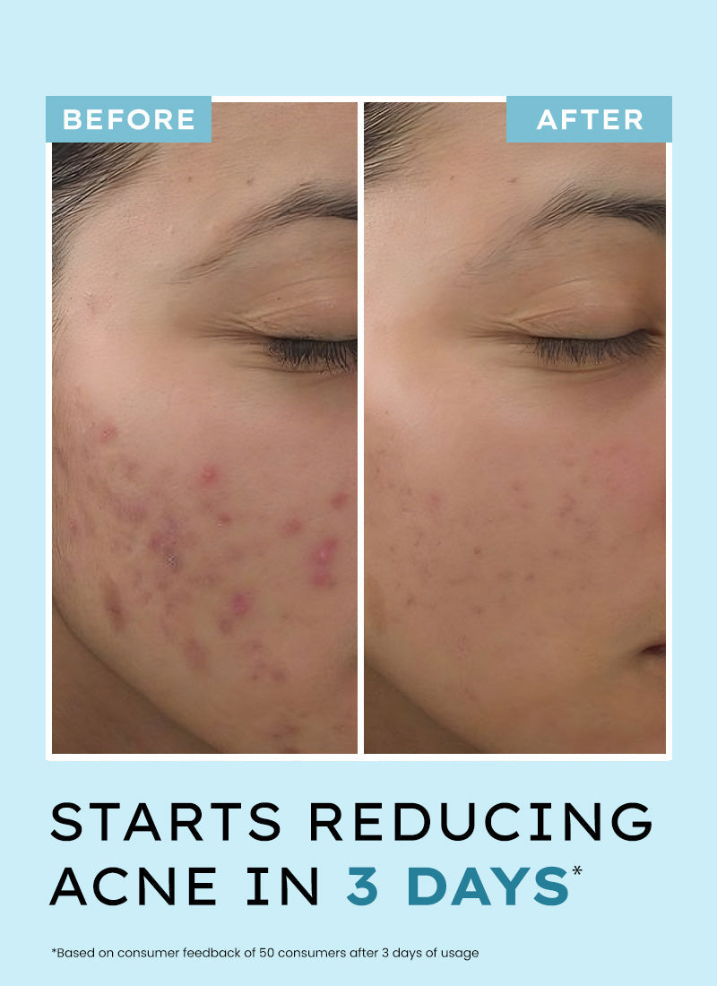 Hyphen Anti acne face serum with 10% azelaic acid & 2% salicylic acid - 30 ml