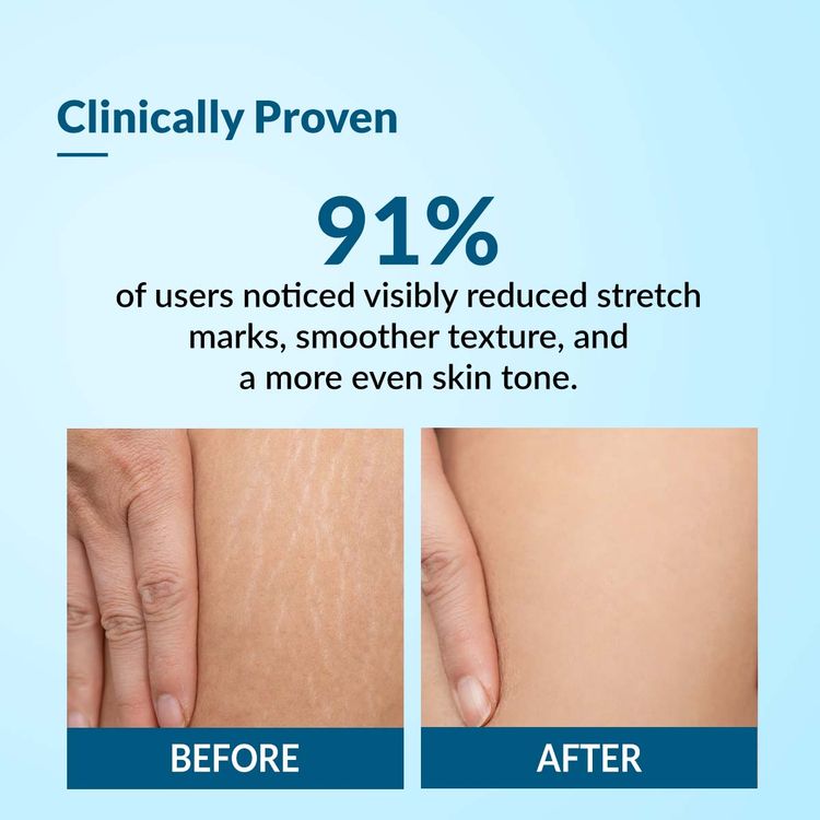 Fixderma
Strallium Stretch Mark Cream
(75 g)