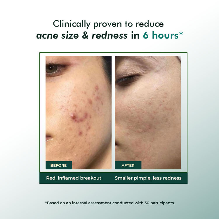 Conscious Chemist
Rapid Relief Acne Spot Corrector Gel (15ml)