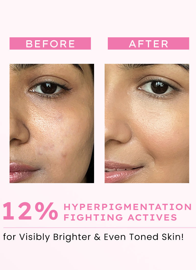 Hyphen Advanced glow serum with 3% tranexamic acid & 2% kojic acid - 30 ml
