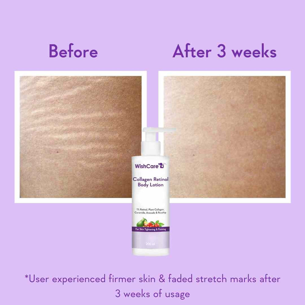 Wishcare Collagen 1% Retinol Body Lotion
Tightens and Firms Body Skin | 200ml