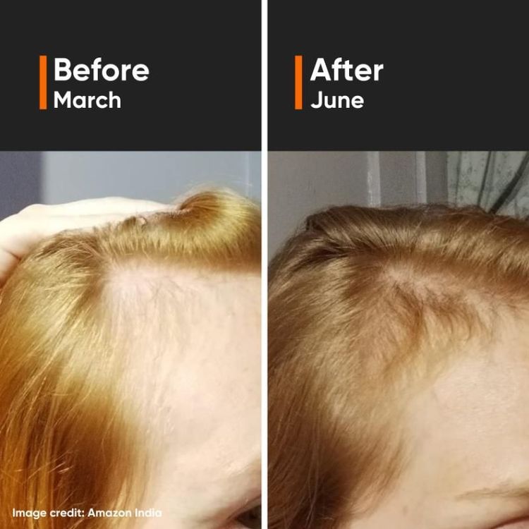 Minimalist Hair Growth Actives 18% Hair Serum
(30ml)
