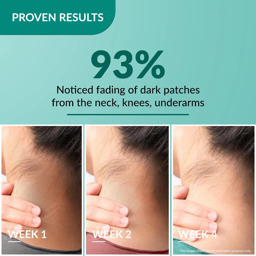 Fixderma Nigrifix Cream | A patented solution to treat hyperpigmentation