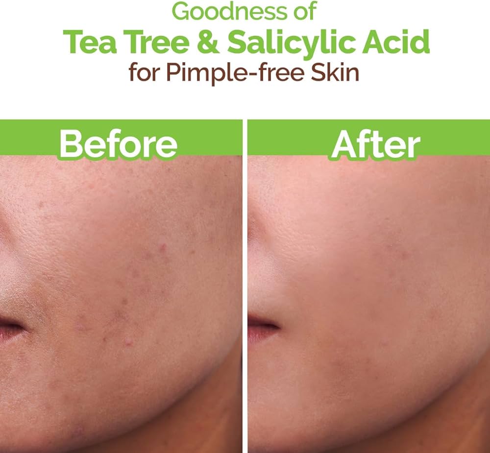 Mamaearth Tea Tree Pimple Control Face Wash with Tea Tree & Salicylic for Oily & Acne-Prone Skin - 100 ml