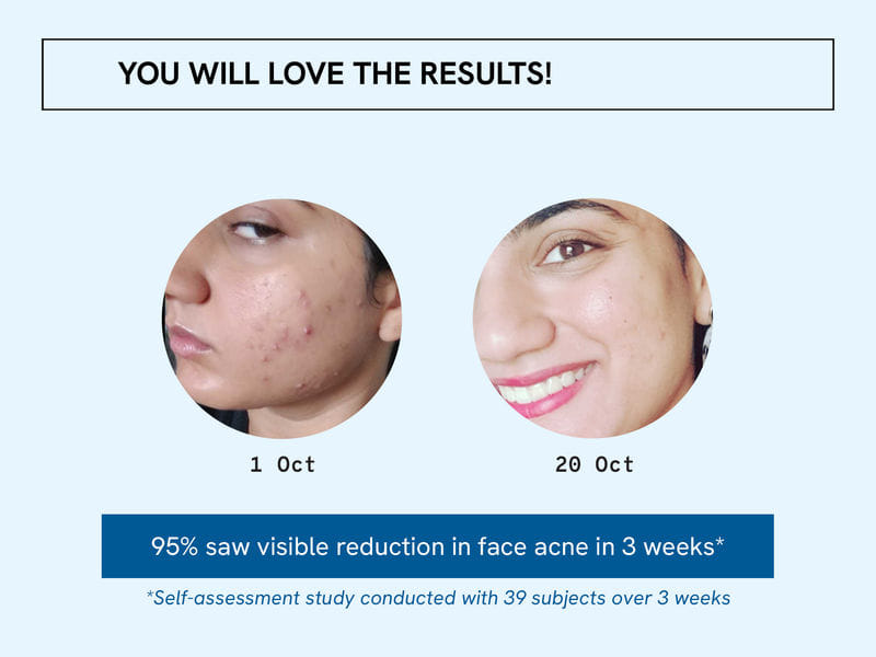 Be Bodywise 2.5% Benzoyl Peroxide Facewash