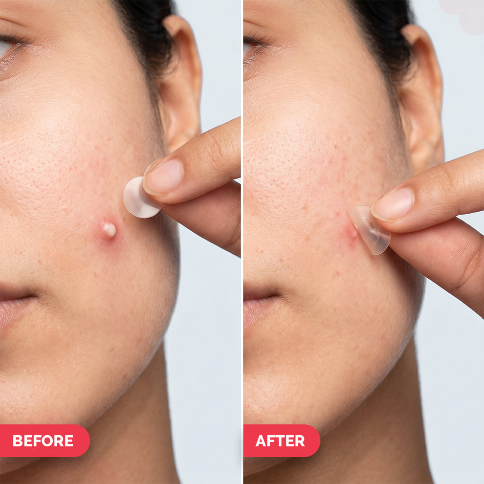 The Derma Co 2% Sali-Cinamide Hydrocolloid Acne Patches - 36 Patches
